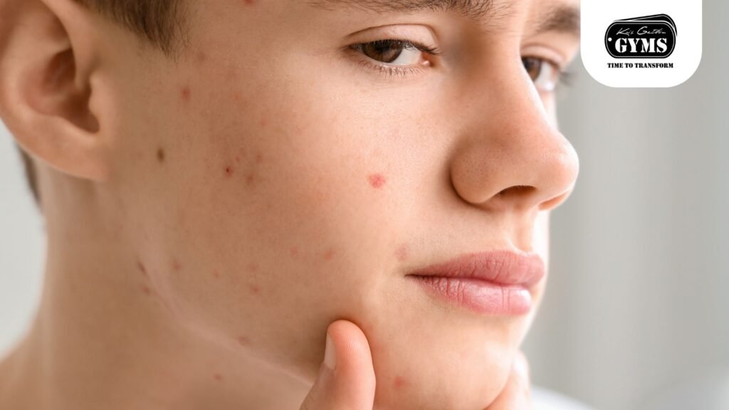Hormonal Cystic Acne The Silent Skin Saboteur You Need To Tackle Now (kris gethin gyms blogs)