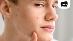 Hormonal Cystic Acne The Silent Skin Saboteur You Need To Tackle Now (kris gethin gyms blogs)
